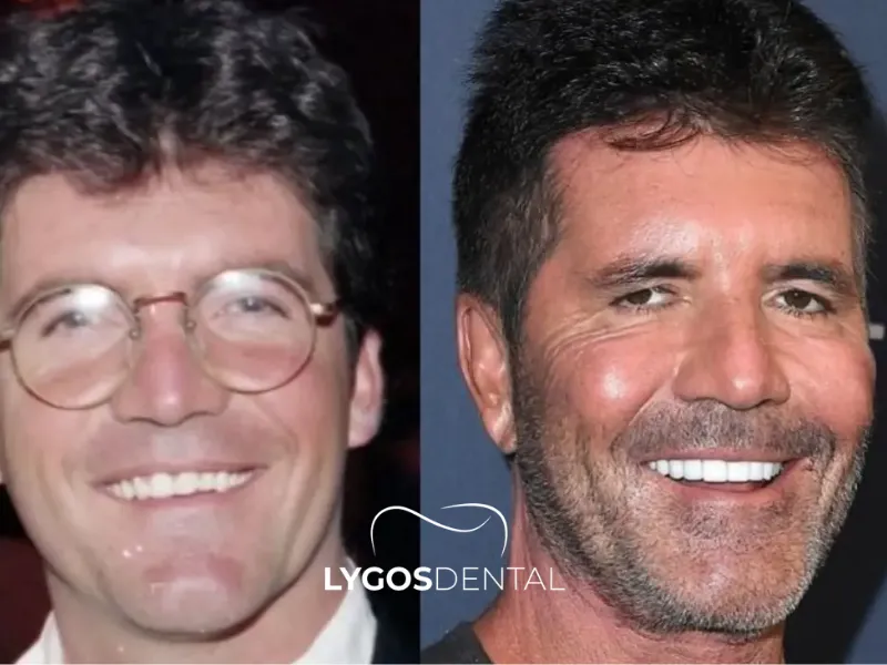 Simon Cowell Estetica dentale | LYGOS DENTAL