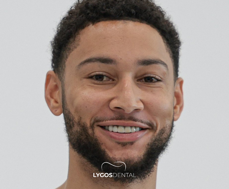 Ben Simmons Diş Estetiği | LYGOS DENTAL 2025