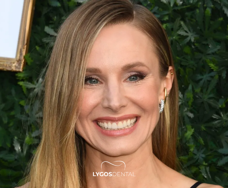 Kristen Bell Diş Kaplamaları | LYGOS DENTAL 2025