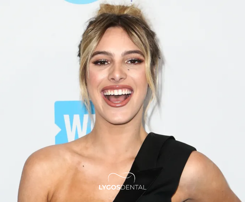 Lele Pons Diş Estetiği | LYGOS DENTAL 2025