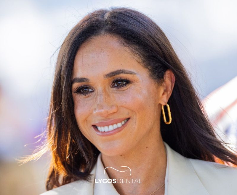 Meghan Markle Dental Aesthetics | LYGOS DENTAL