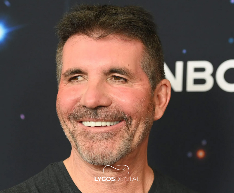 Simon Cowell Dental Aesthetics | LYGOS DENTAL 2025