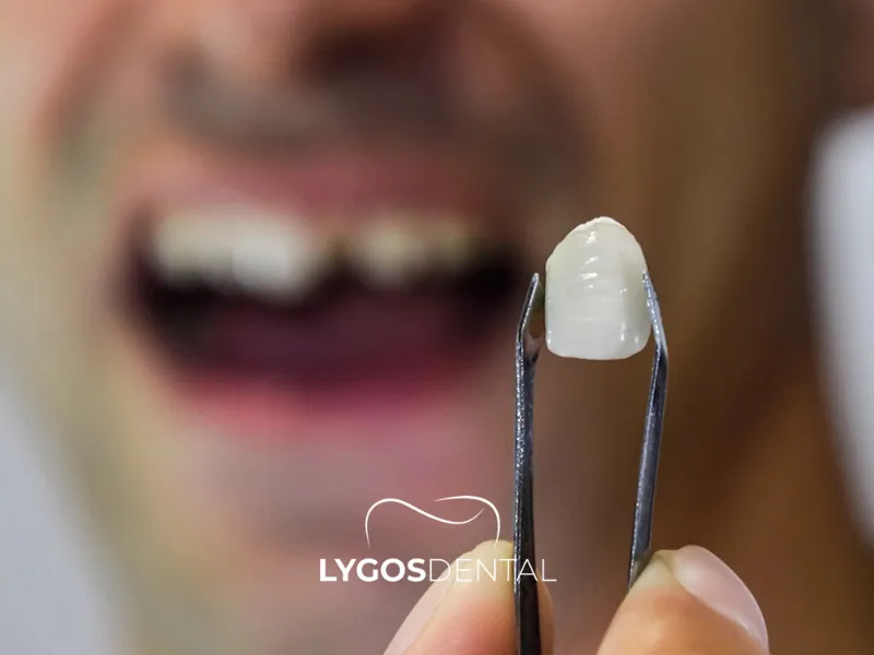 Ti è caduta una corona dentale?