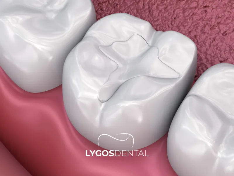 Как долго длится боль после пломбирования? | LYGOS DENTAL