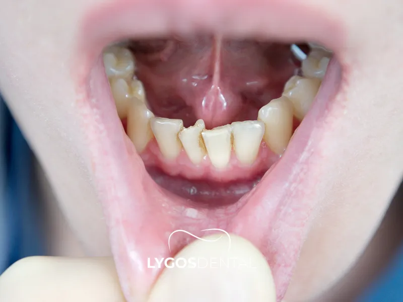 Come correggere i denti storti