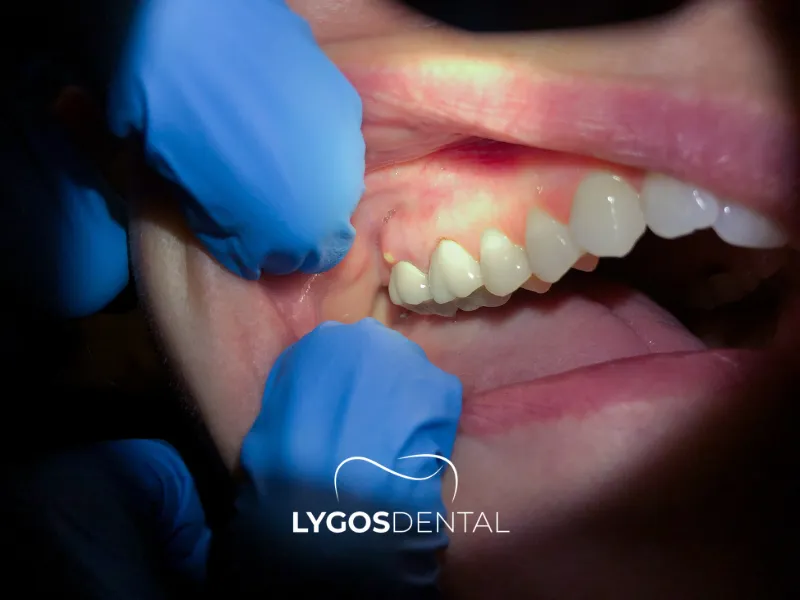 Симптомы поражения зубов | LYGOS DENTAL
