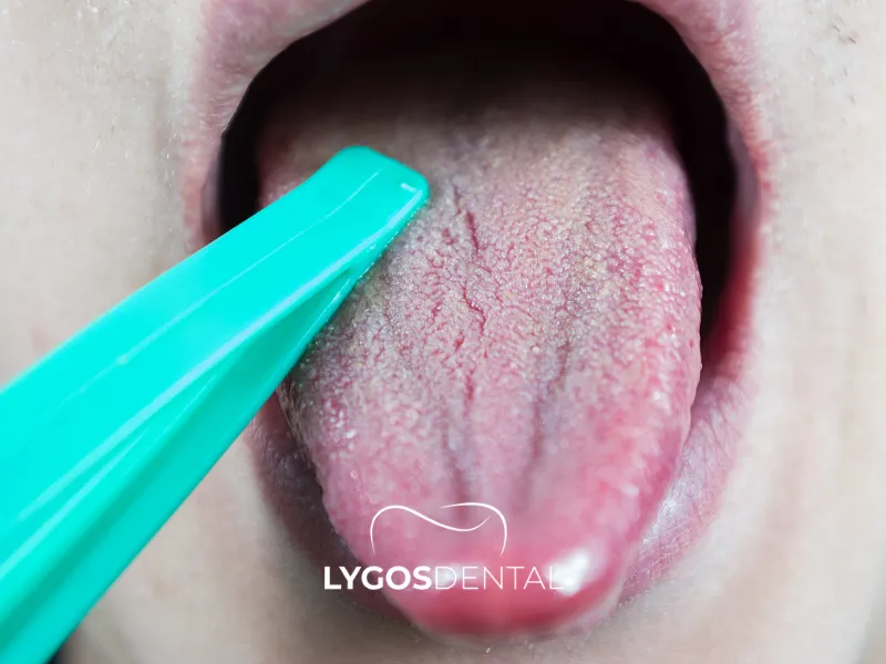 Что вызывает переломы зубов? | LYGOS DENTAL