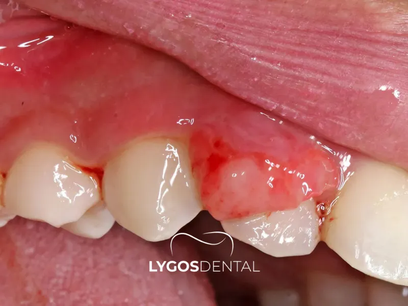 Che cos’è il cancro alle gengive?