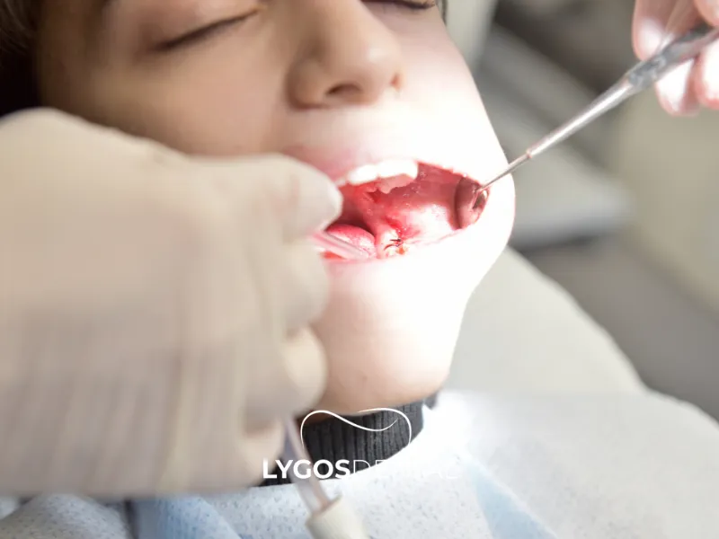 Что такое киста зуба? | LYGOS DENTAL