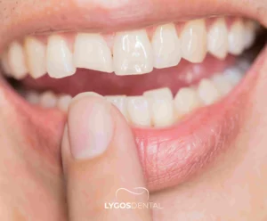 Diş Kırılması Neden Olur? | LYGOS DENTAL