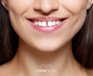 Gappy Teeth: Causes, Treatment & Prevention | LYGOS DENTAL