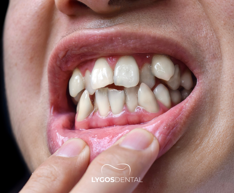 How to Fix Crooked Teeth? | LYGOS DENTAL