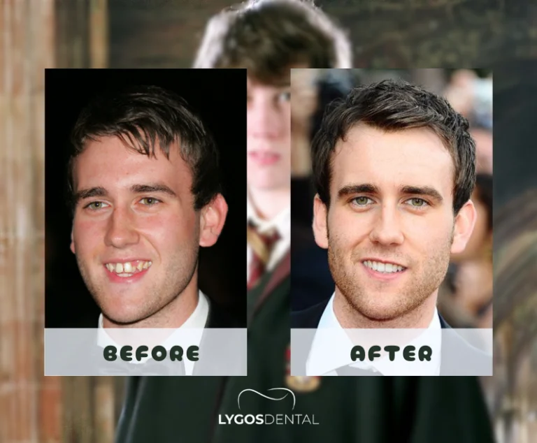 Matthew Lewis Teeth Before And After