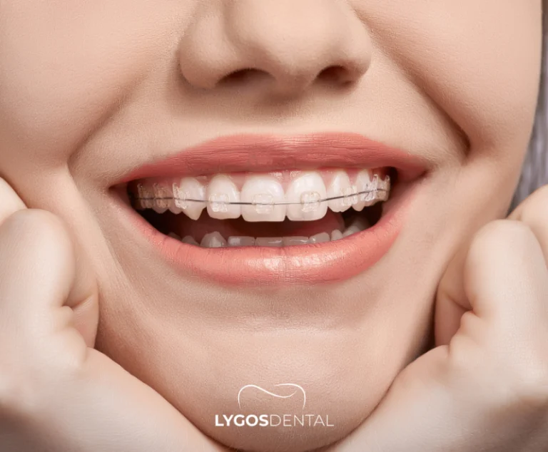 Orthodontic Treatments for Straightening Crooked Teeth