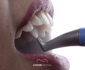 Painless Teeth Cleaning with Airflow | LYGOS DENTAL