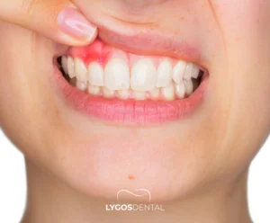What Are the Symptoms of a Tooth Lesion? | LYGOS DENTAL
