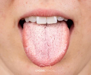 What Causes Dry Mouth?| LYGOS DENTAL