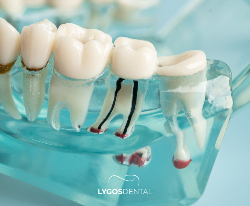 What is a Root Cavity? | LYGOS DENTAL