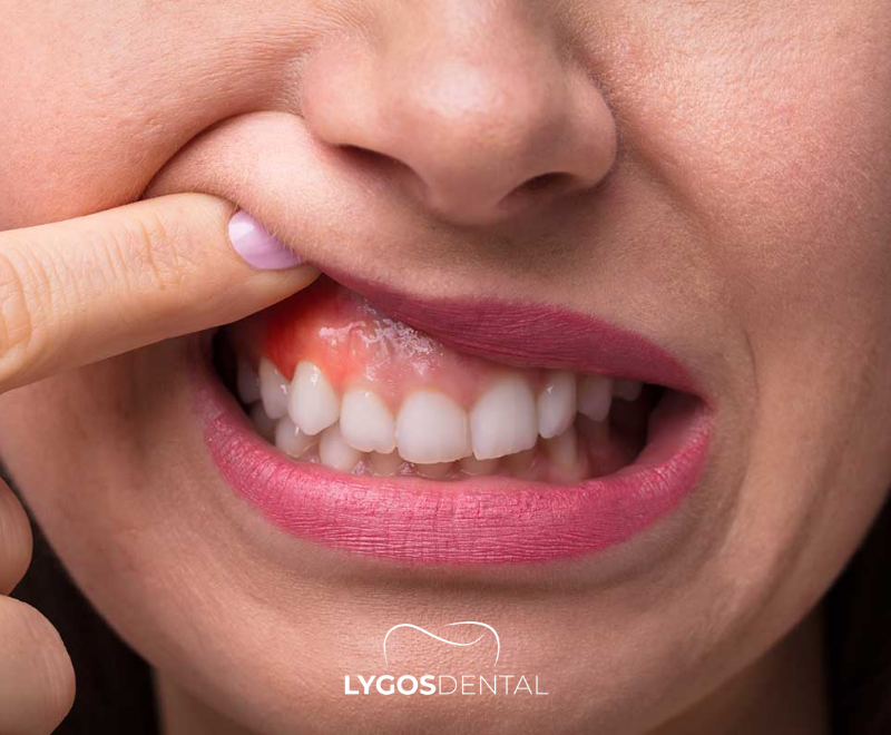 What is Gum Cancer? | LYGOS DENTAL