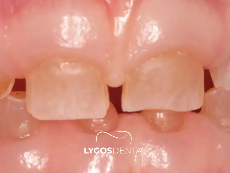 Dentinogenesi imperfetta