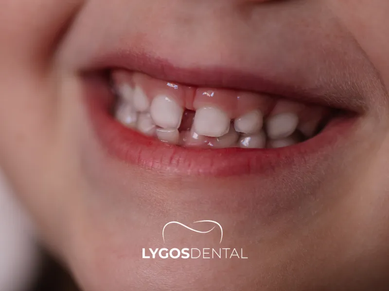 È possibile curare i denti da latte?