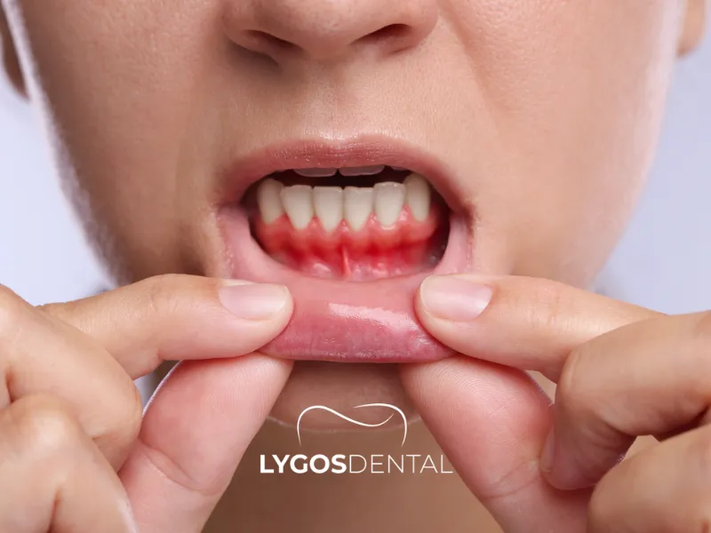 Cosa si può fare per alleviare il dolore alle gengive?