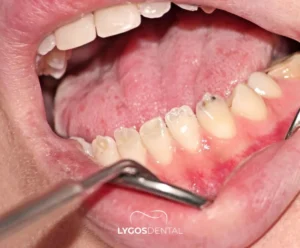 Dentinogenezis İmperfekta | LYGOS DENTAL