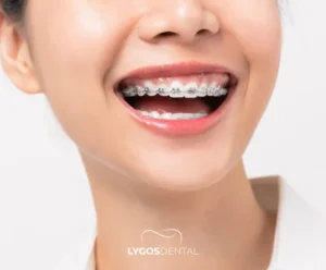 Diş Teli Nedir? | LYGOS DENTAL