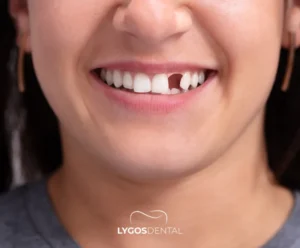 What is Anodontia? | LYGOS DENTAL