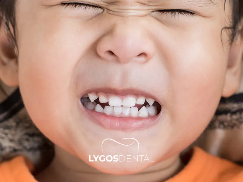 Il bruxismo nei bambini (digrignare i denti)