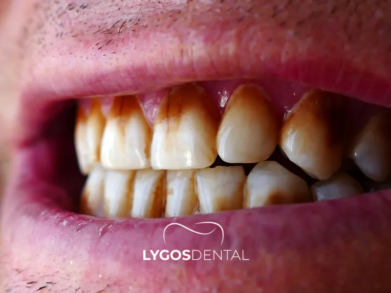 I denti diventano più bianchi dopo aver smesso di fumare?