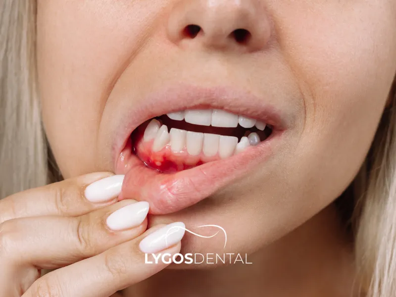 Cum afectează bolile gingiilor sănătatea inimii? | LYGOS DENTAL