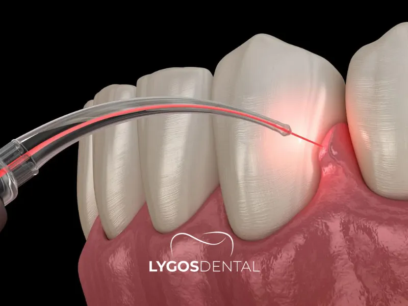 Trattamento gengivale con laser