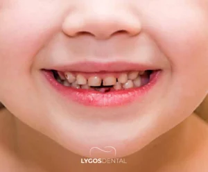 Biberon Çürüğü Nedir? | LYGOS DENTAL