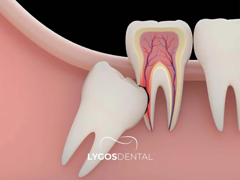 Cosa succede se un dente incluso non viene estratto?