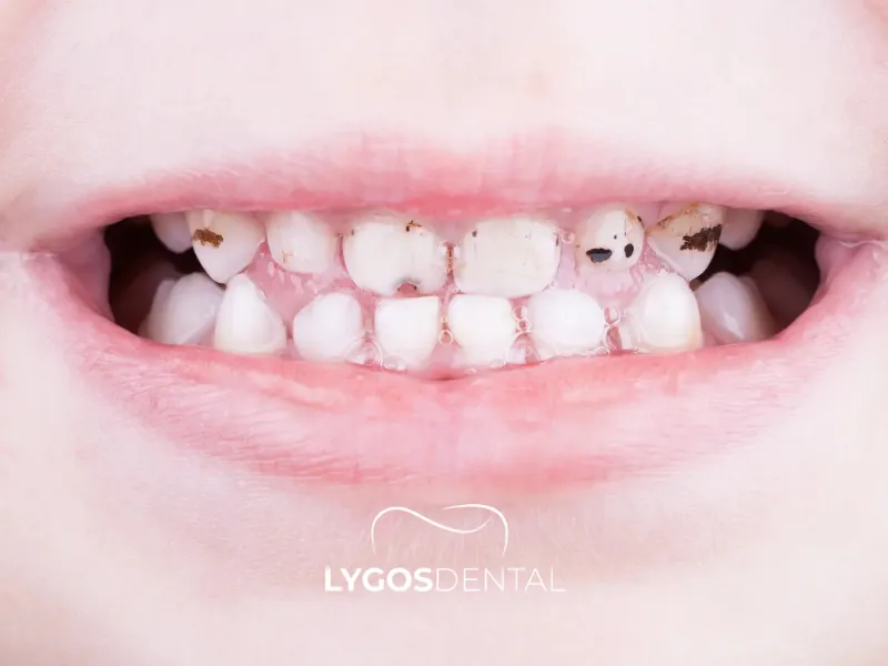 Che cos’è la carie da biberon