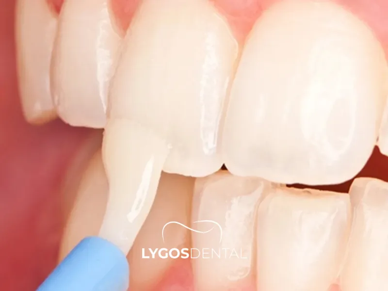 Che cos’è il trattamento al fluoro?