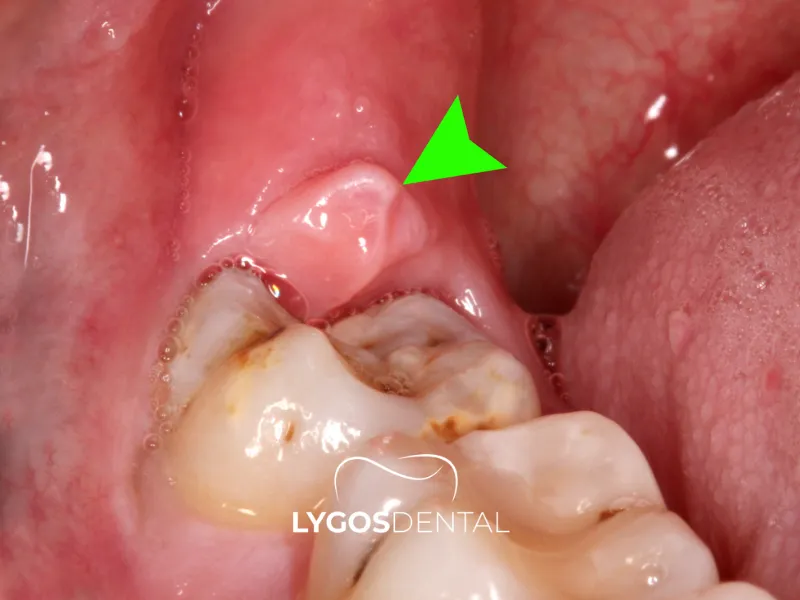 Che cos’è la pericoronite? | LYGOS DENTAL