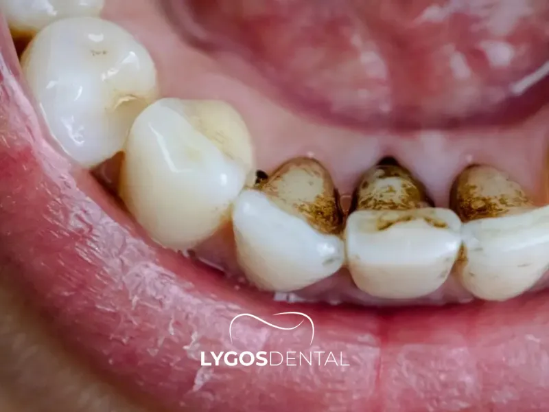 Che cos’è una macchia dentale da tetraciclina?