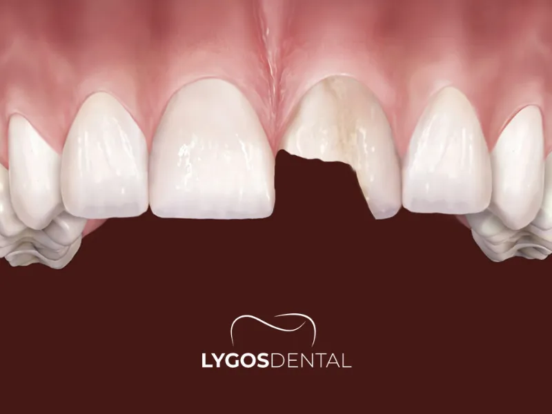 Cosa fare se si rompe una faccetta in laminato?