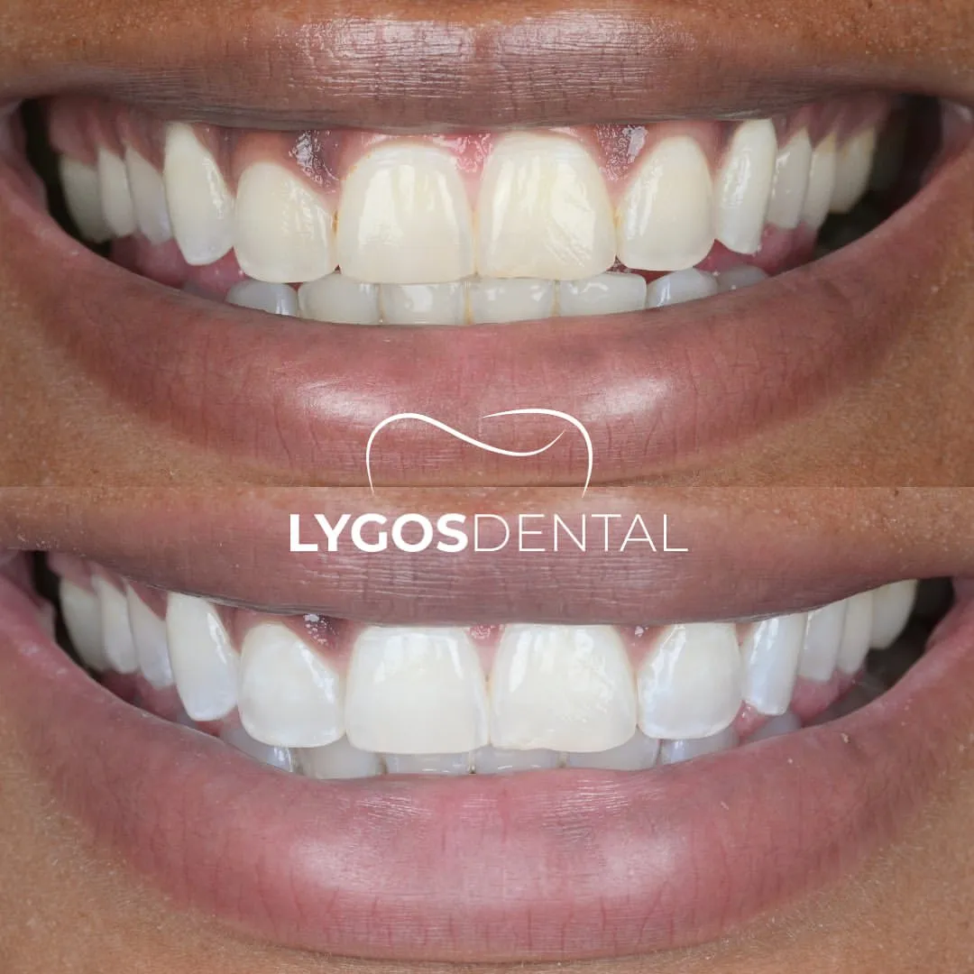 teeth whitening before after