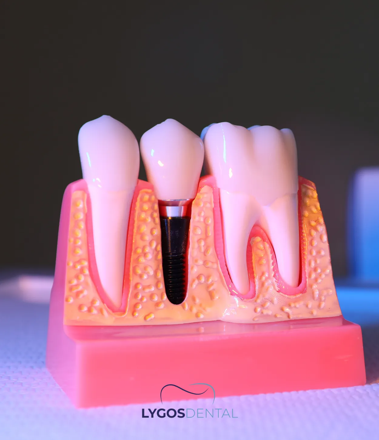 dental implants turkey