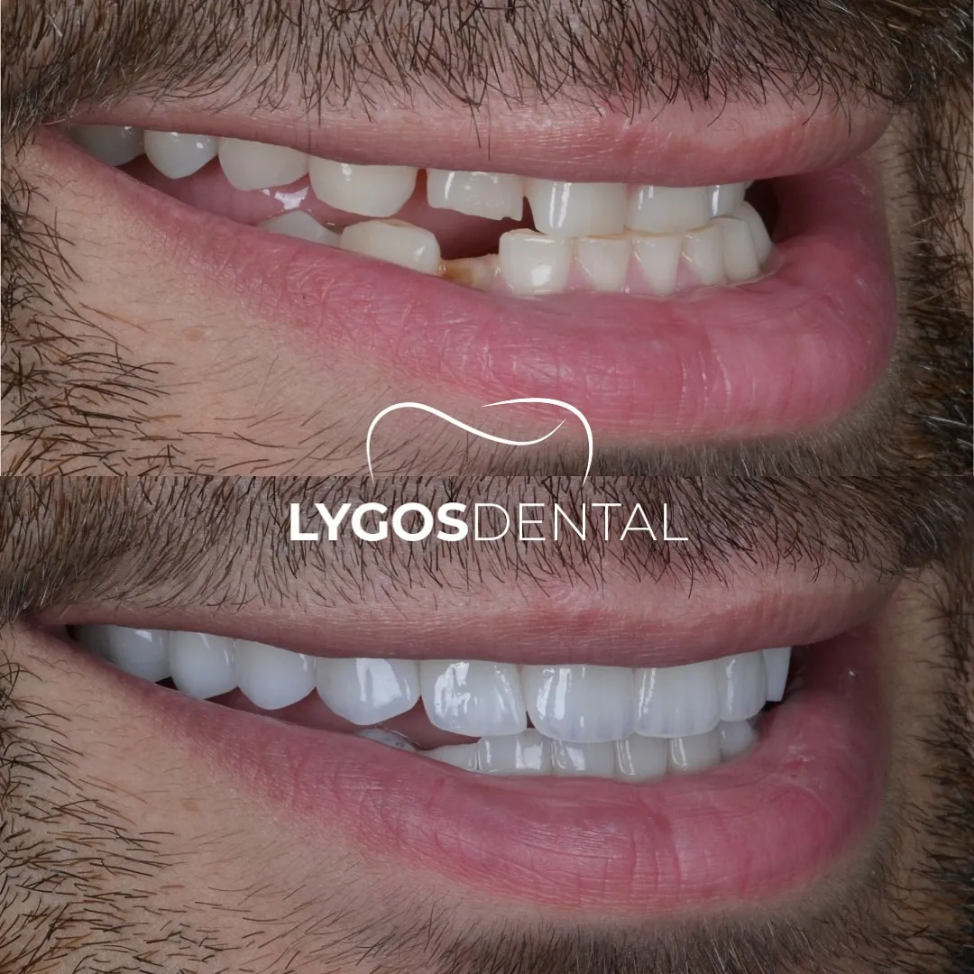 emax veneer before and after