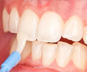 Flor Uygulaması Nedir? | LYGOS DENTAL