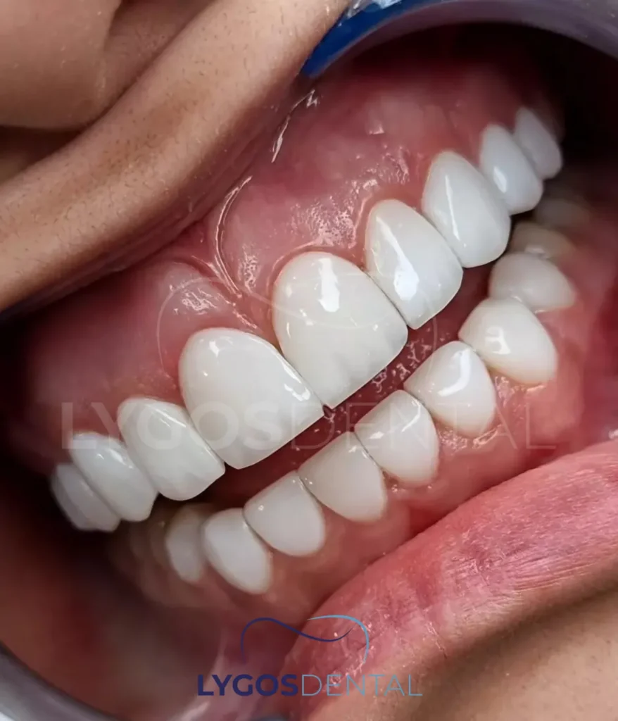 hollywood smile in turkey