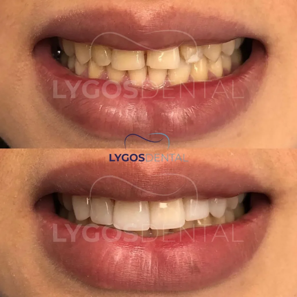 home bleaching teeth whitening