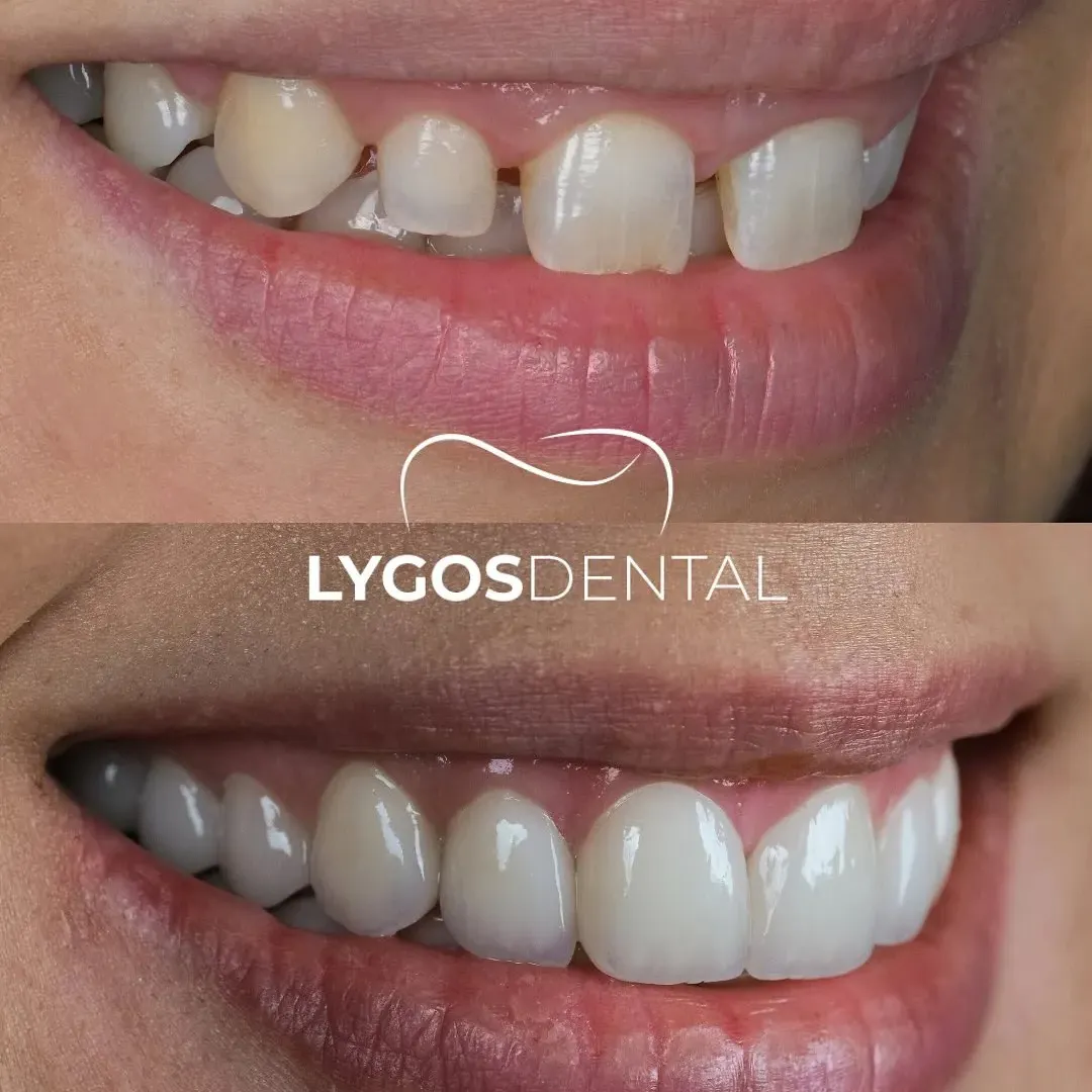 laminate veneer before after