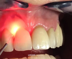 Lazerle Diş Eti Tedavisi | LYGOS DENTAL