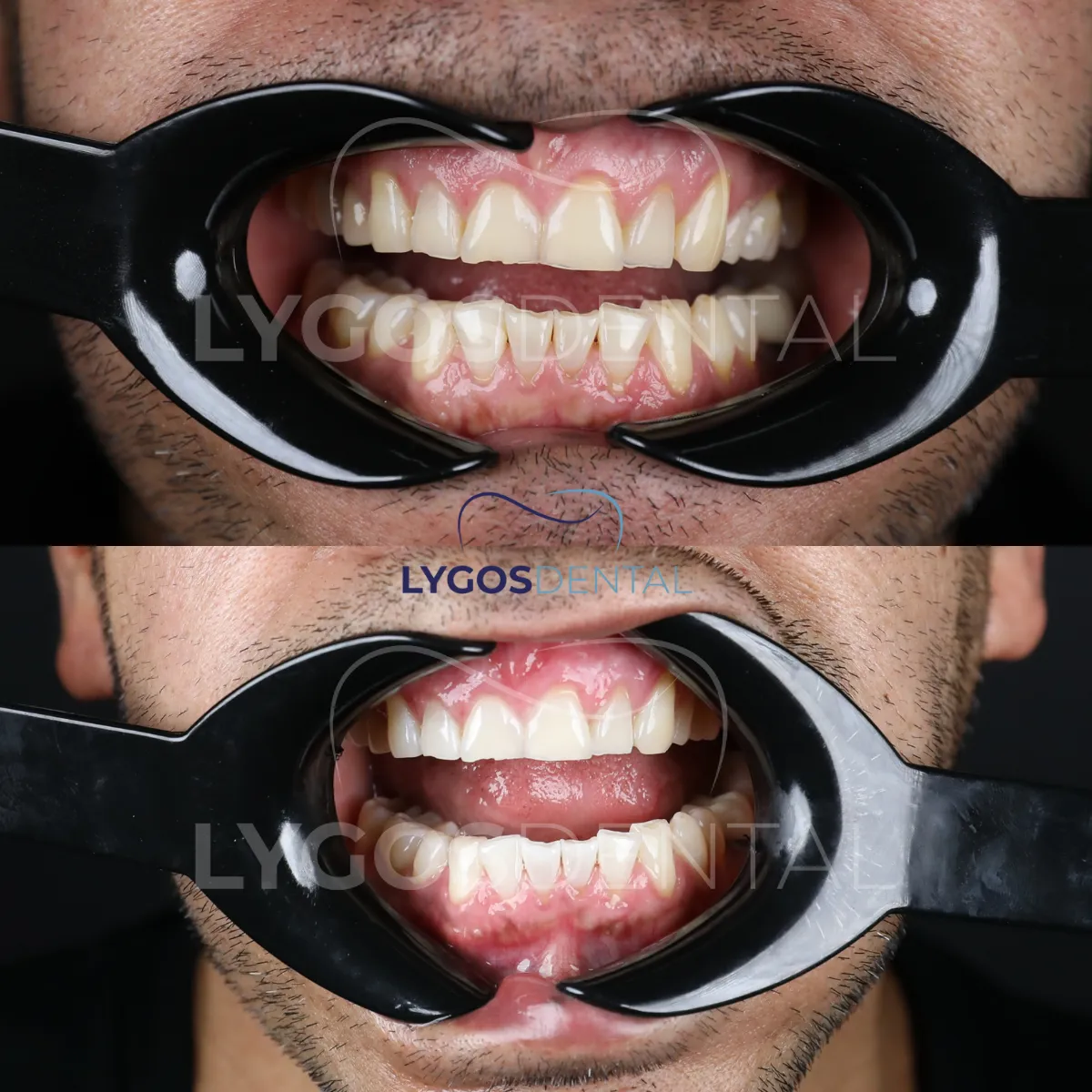 professional teeth whitening