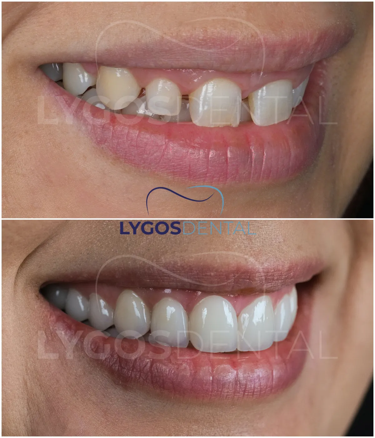 smile design in turkey